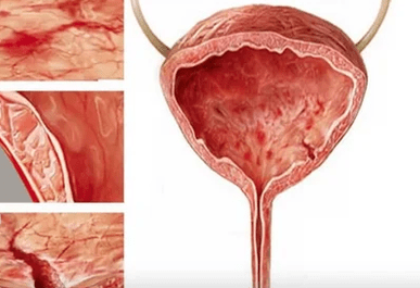 Causes of women's cystitis